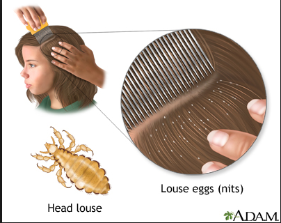 Head Lice Epidemic